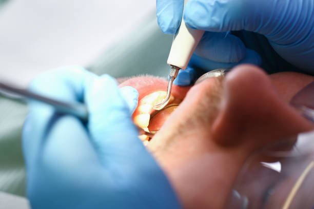 Best Emergency Treatment for Dental Infections or Abscesses in Reminderville, OH