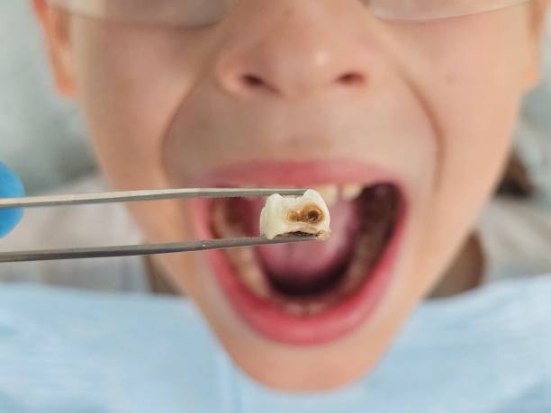 Best Emergency Dental Care for Broken or Chipped Teeth in Reminderville, OH