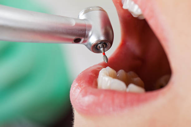 Best Emergency Dental Care for Broken or Chipped Teeth in Reminderville, OH